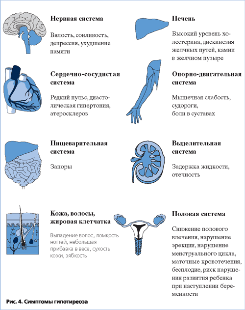 Гипотиреоз